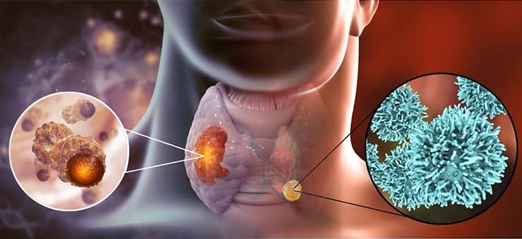 Câncer de Tireoide: Diagnóstico, Procedimentos Cirúrgicos e Formas de Tratamento