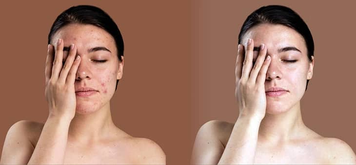 Pincel de Recuperação no Photoshop-Como remover acne e manchas de pele